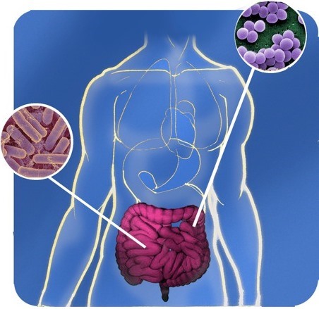 Morbo Di Crohn Malattia Cronica Intestinale: Sintomi, Trattamenti Ed ...